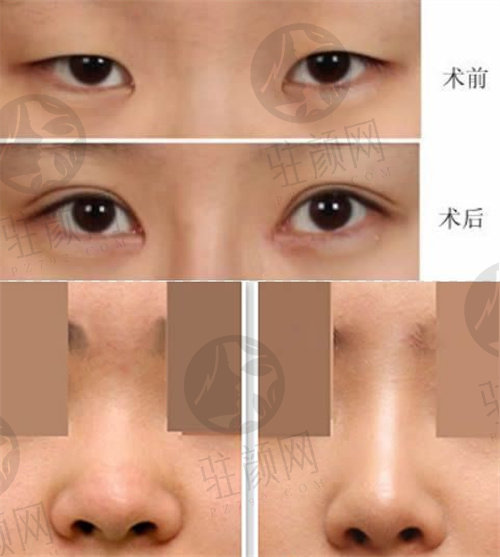 泉州东大医疗美容陈逸华双眼皮及隆鼻<span style=