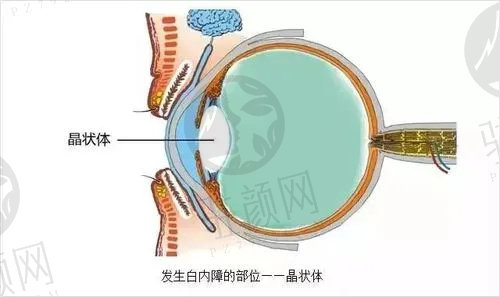 重庆千叶眼科医院白内障病变图