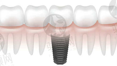长春传阳口腔医院种植牙