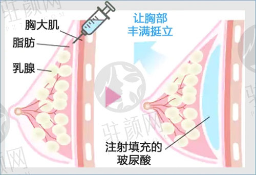 深圳富华隆胸怎么样