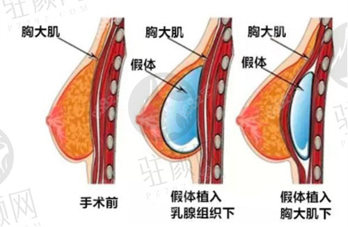 深圳富华隆胸怎么样