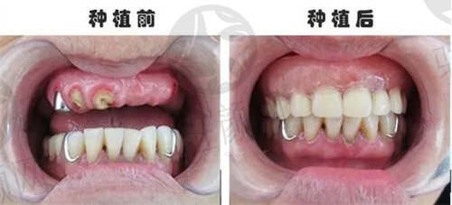 成都新桥口腔医院种植牙前后对比