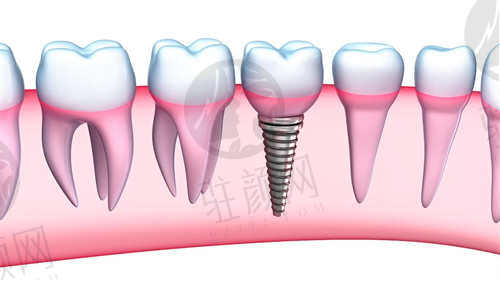杭州牙科医院丽水口腔分院种植牙