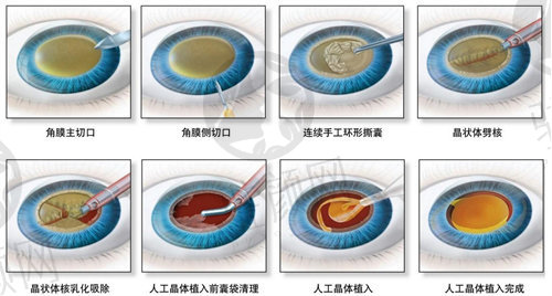 郑州视献眼科医院高月白内障超声乳化手术