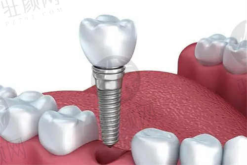 重庆齐美口腔医院种植牙