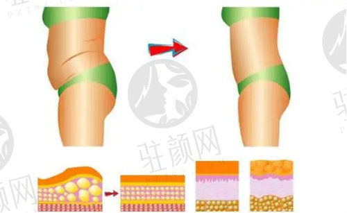 王焕医生做吸脂手术好吗