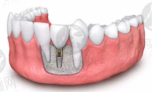 常州北极星口腔罗新宇医生瑞士ITI种植牙价格12800元起