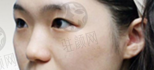 我的“小翘鼻”蜕变之路：分享我在邯郸华美医疗美容徐长帅医生那做的<span style=