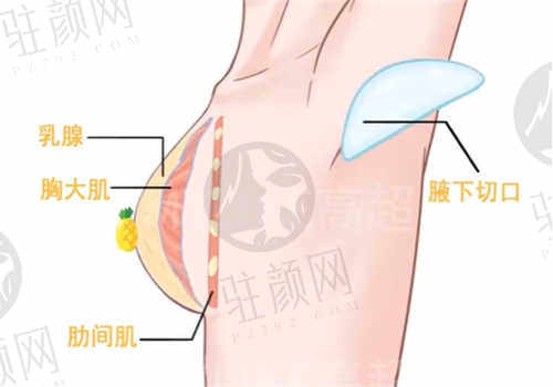 厦门薇格整形外科门诊部隆胸患者评价