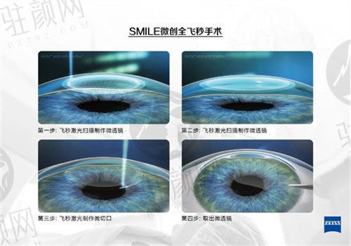 绍兴爱尔眼科医院赵炳坤医生全飞秒手术演示图
