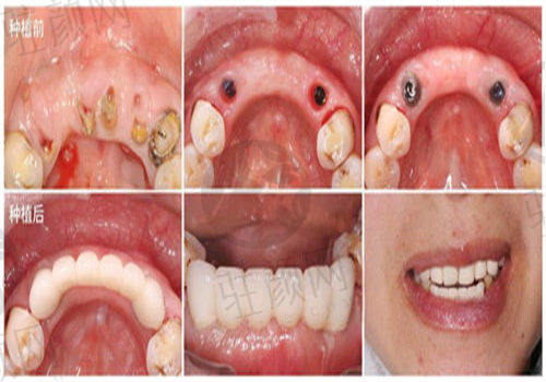 厦门优梨口腔医院秦红艳种植牙示例2