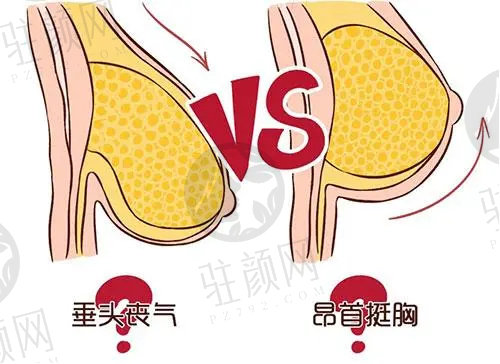 乳房下垂矫正手术优势