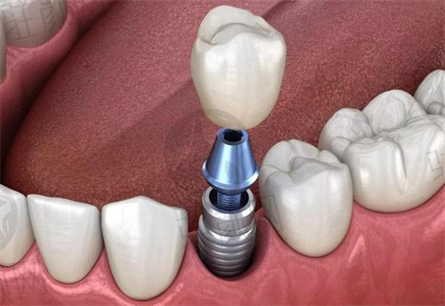 广州柏德口腔医院种植牙怎么样