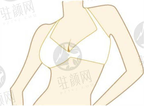 赵绛波医生乳房下垂矫正特色