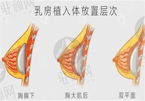 假体隆胸