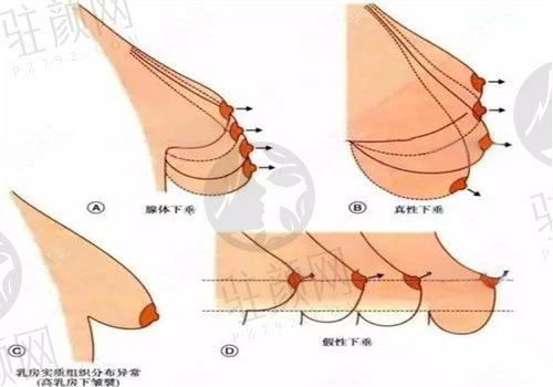 胸下垂矫正术