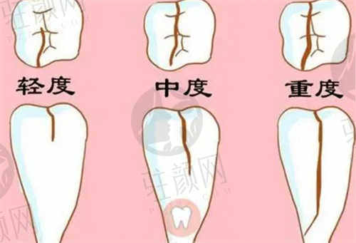 郑州精益口腔医院登腾种植体怎么样