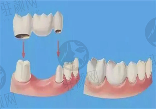 天水兔博士口腔医院能做搭桥牙吗