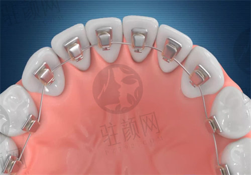深圳鼎植口腔牙齿矫正怎么样