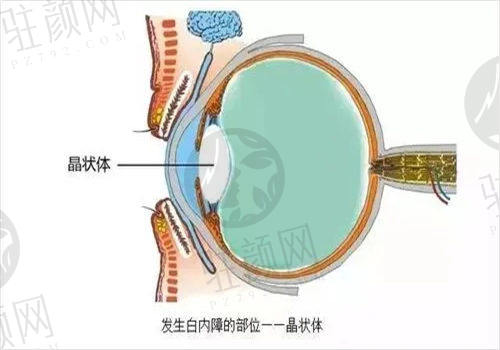 福州亮睛眼科医院白内障免费是真的吗