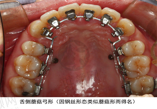 佛山曙光金子口腔医院牙齿矫正价格