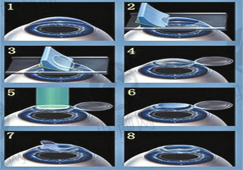 天津滨海国泰眼科医院全飞秒近视手术
