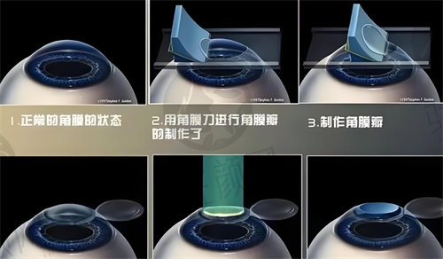 商丘尖峰眼科医院特色手术项目