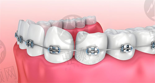 西安中诺口腔医院雅安吃矫正术后注意事项：