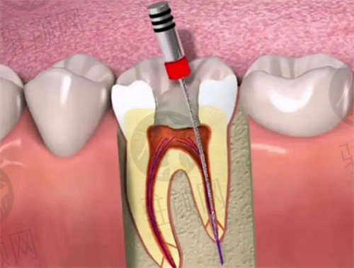 重庆天福华怡口腔门诊给我使用的是显微根管治疗技术