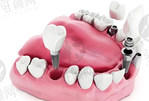 达州医 大口腔医院种植牙术后注意事项