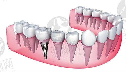 淄博可恩口腔医院单颗种植牙有哪些优势