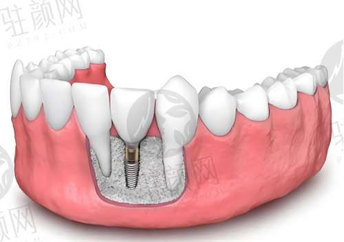 淄博可恩口腔医院单颗种植牙术后注意事项