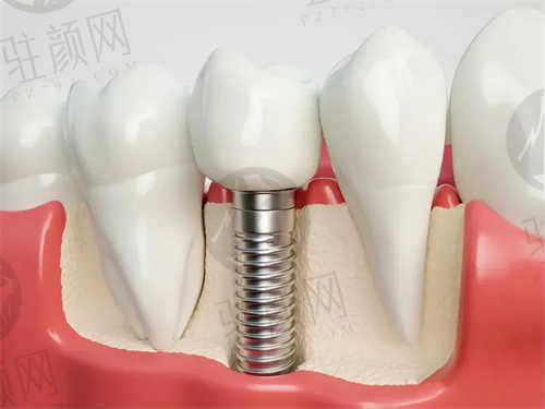 慈溪雅冠口腔种植牙项目介绍