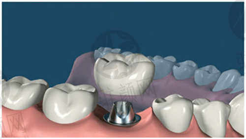 吉林市臻美口腔门诊部种植牙过程