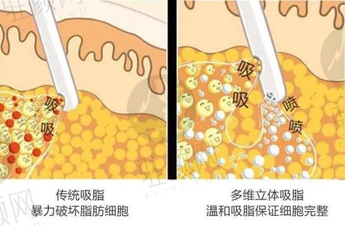 八大处全身吸脂手术的价格是多少