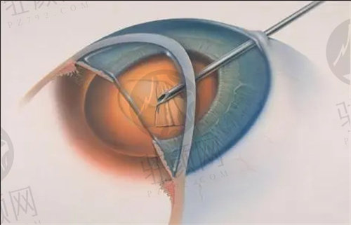 北京民众眼科医院白内障手术有名医生