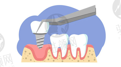 绍兴金柯桥口腔诊疗中心种植牙
