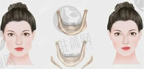 沈阳杏林医院正颌手术价格表