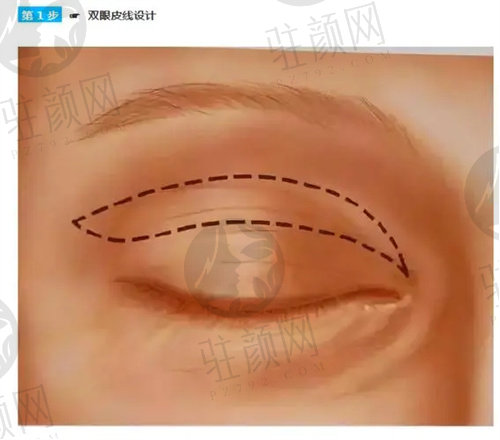 刘冰医生做双眼皮手术的优势