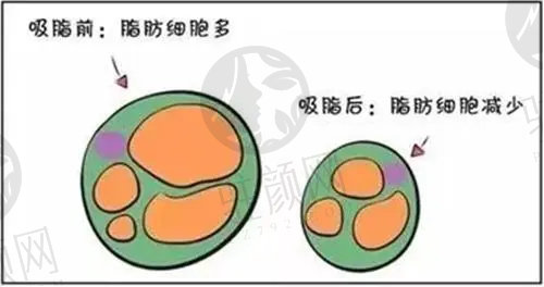 深圳富华医疗美容医院吸脂多少钱