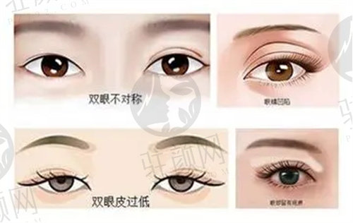 大连爱德丽格刘志刚修复双眼皮怎么样