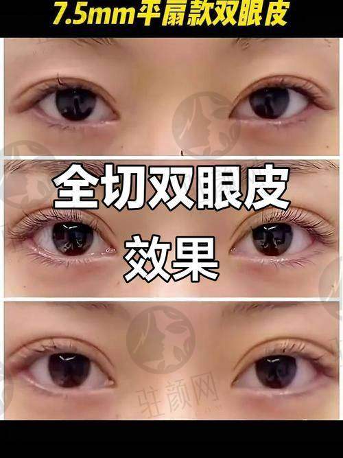 成都其他双眼皮修复医生特色