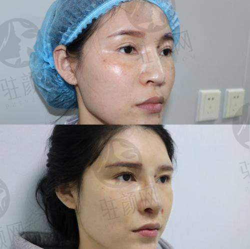 术后后期成效显现
