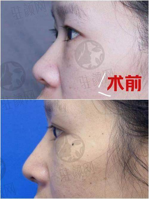自体软骨隆鼻费用影响因素