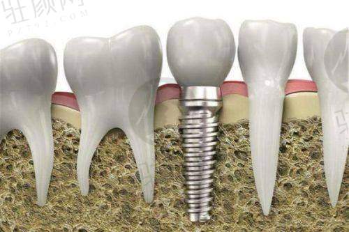 深圳福华口腔价格体系