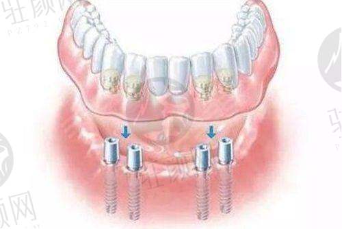 黄盛兴医生——种植牙领域的具有影响力骨干医生