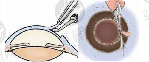 4. 北京普瑞华德眼科医院医生预约方式